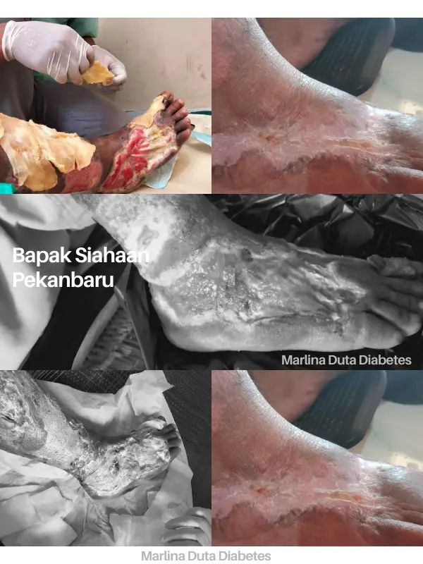 Dokumentasi Kaki Sembuh Diabetes