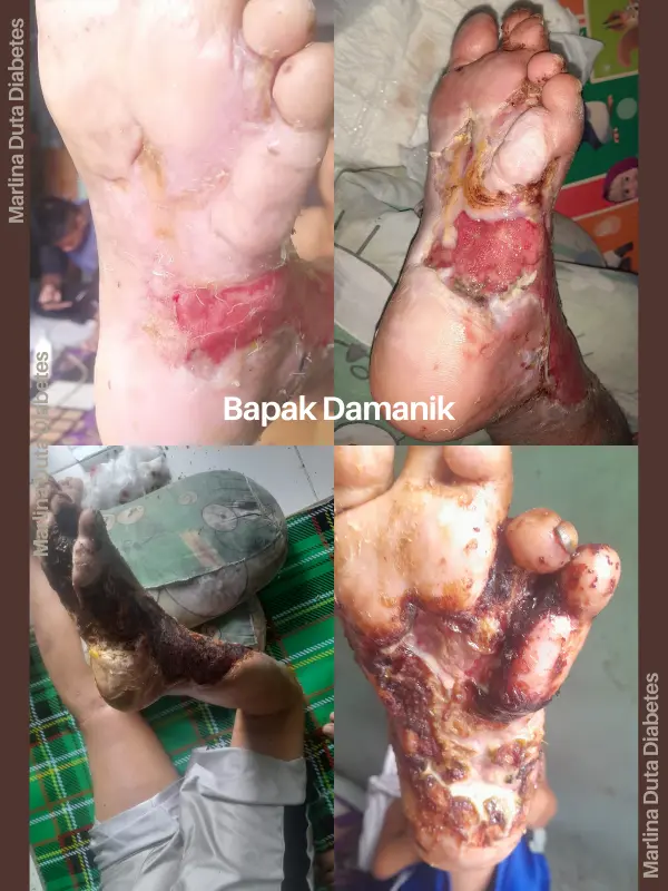 Hasil Akhir Sembuh Total